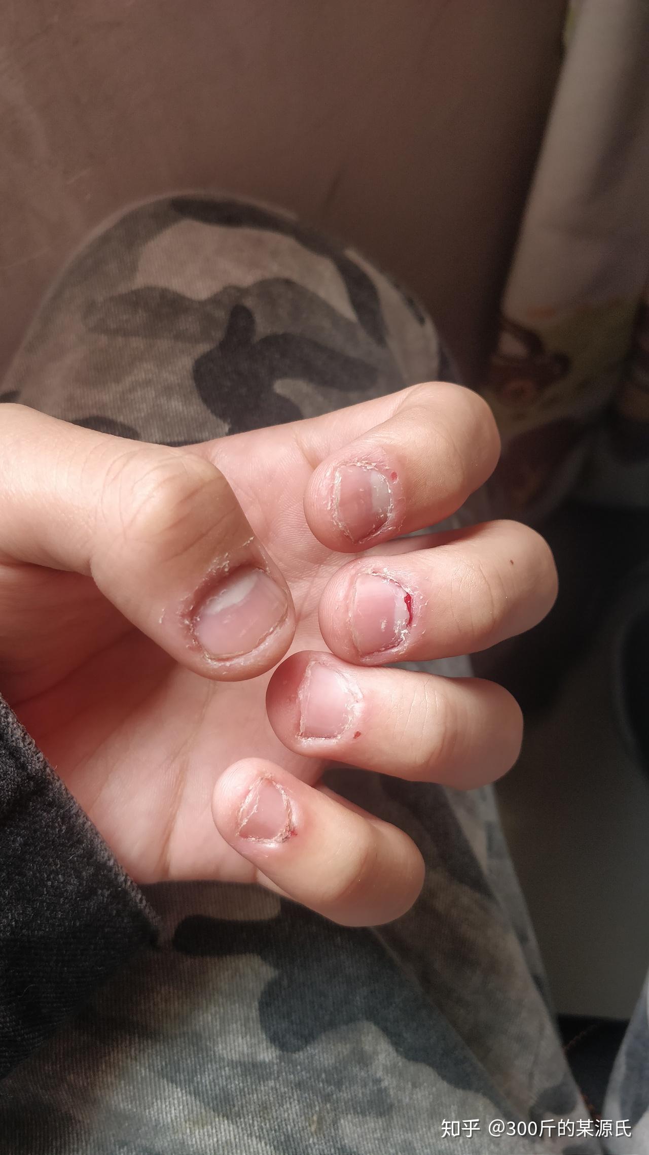 我想改掉抠手指的习惯,但是学习和紧张的时候,还是特别需要发泄焦虑的