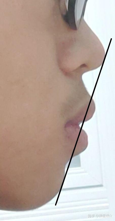 嘴唇比较厚侧面看起来很突出怎么办