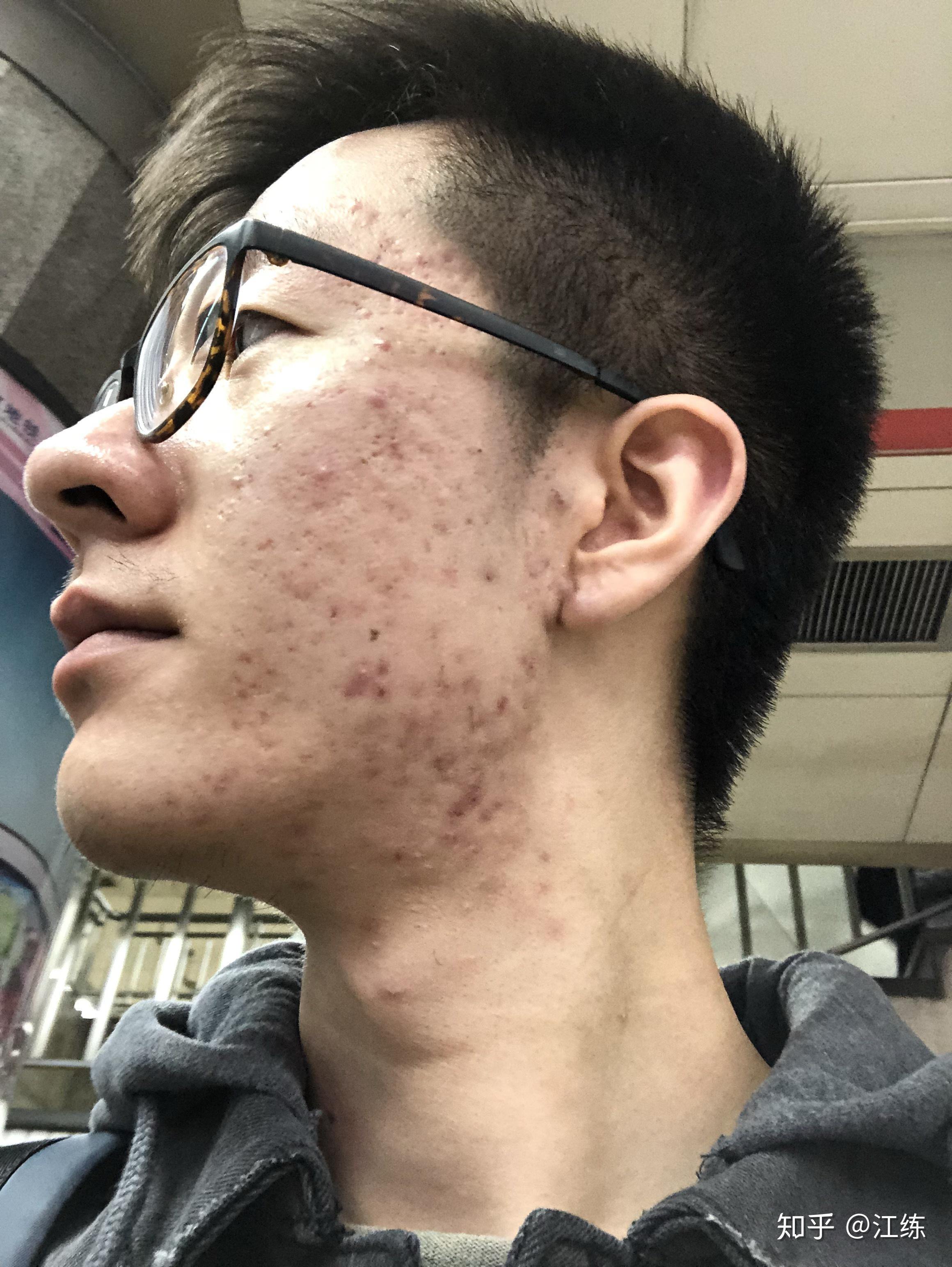 是不是脸上有痘痘的男孩子女生都不喜欢? - 知乎