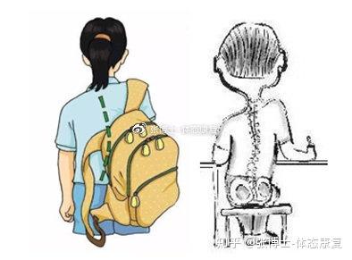 【案例分析】青少年功能性脊柱侧弯与“剃刀背”矫正案例 - 知乎