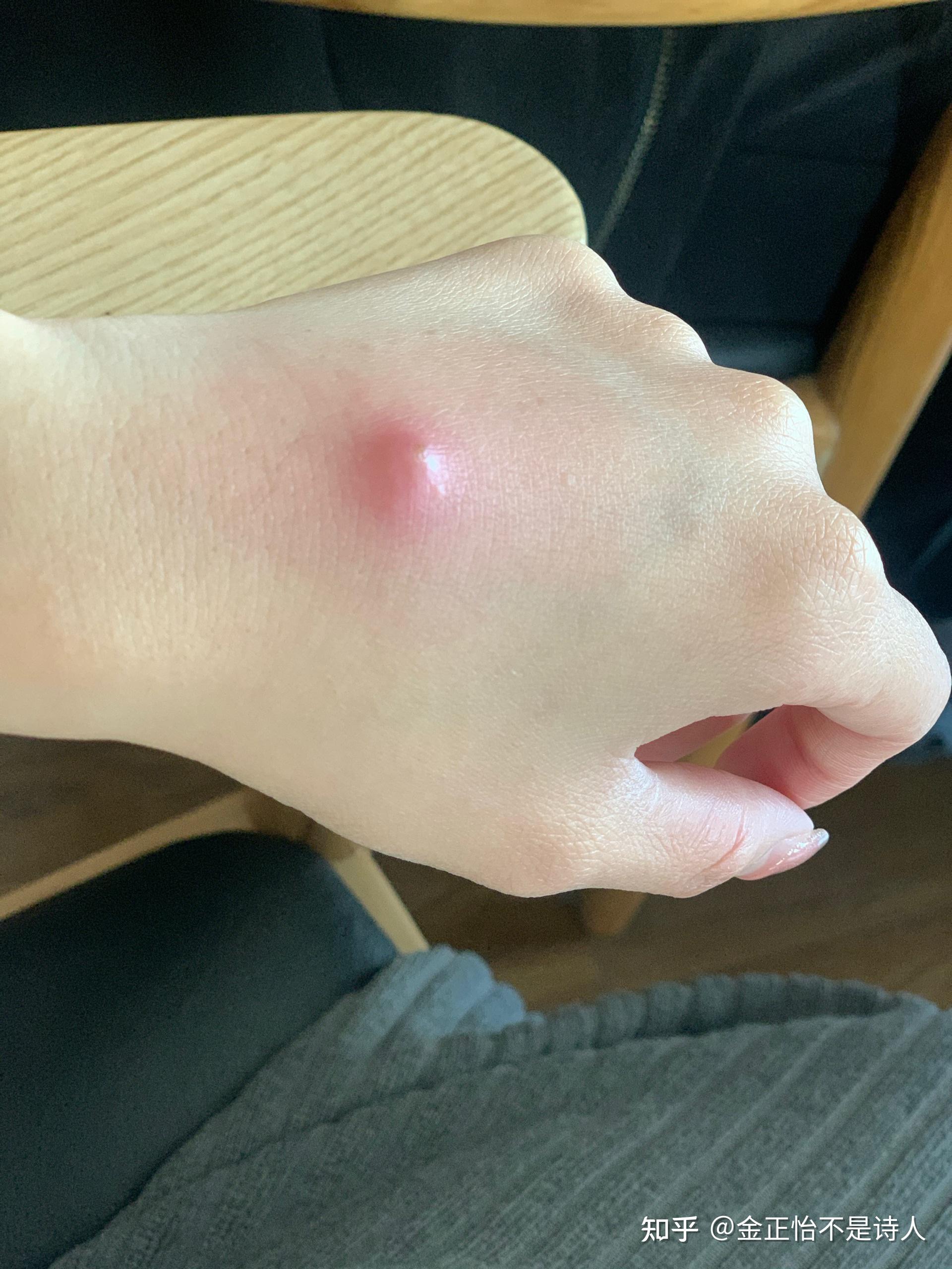 一个火疖子能大到什么地步? - 知乎