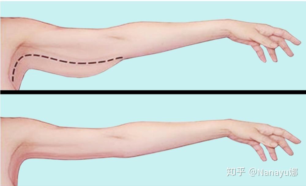 女生如何减去腋下和手臂的拜拜肉?