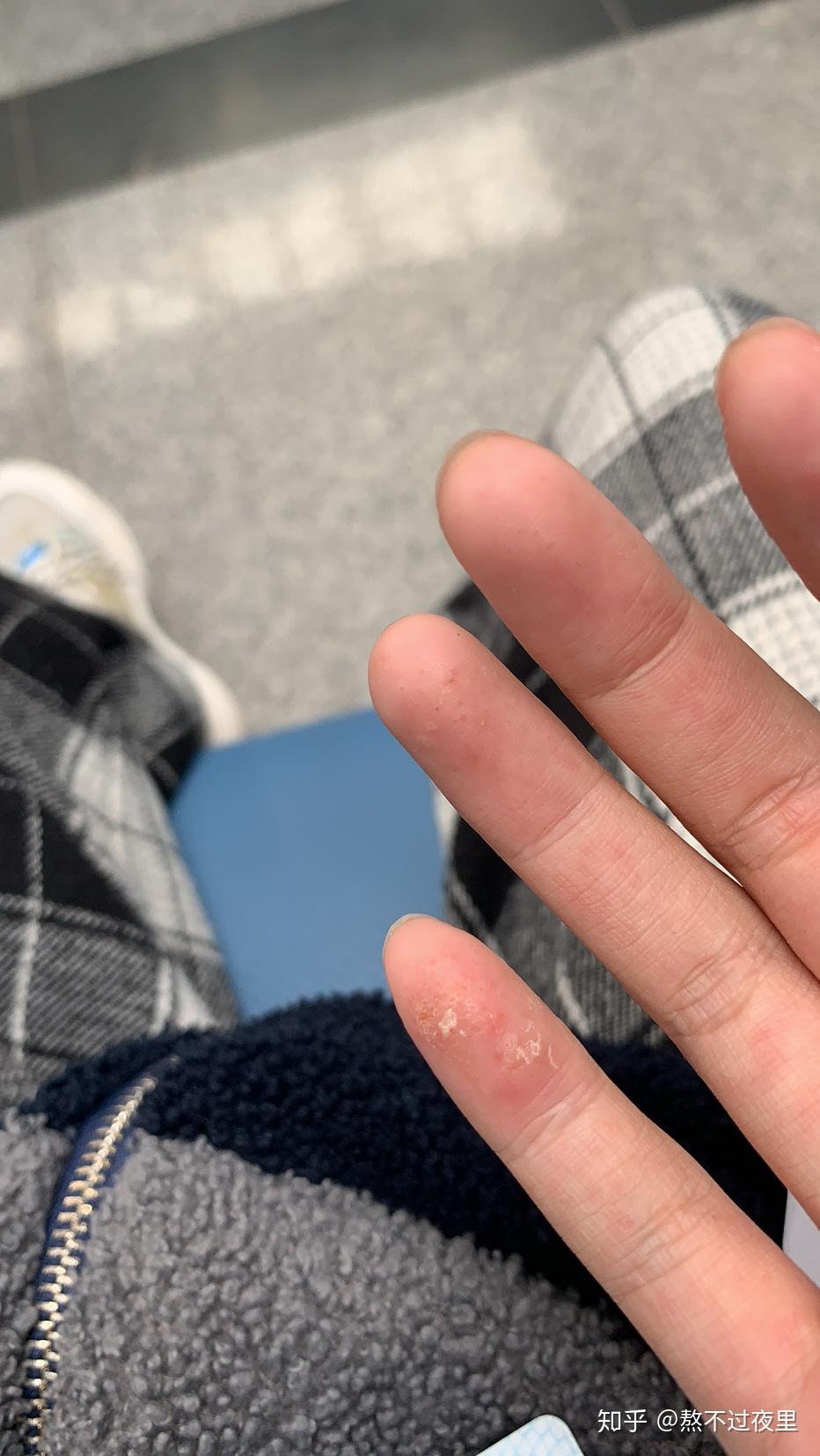 夏天手上总是起汗孢疹基本年年都会复发怎样才能根治呢