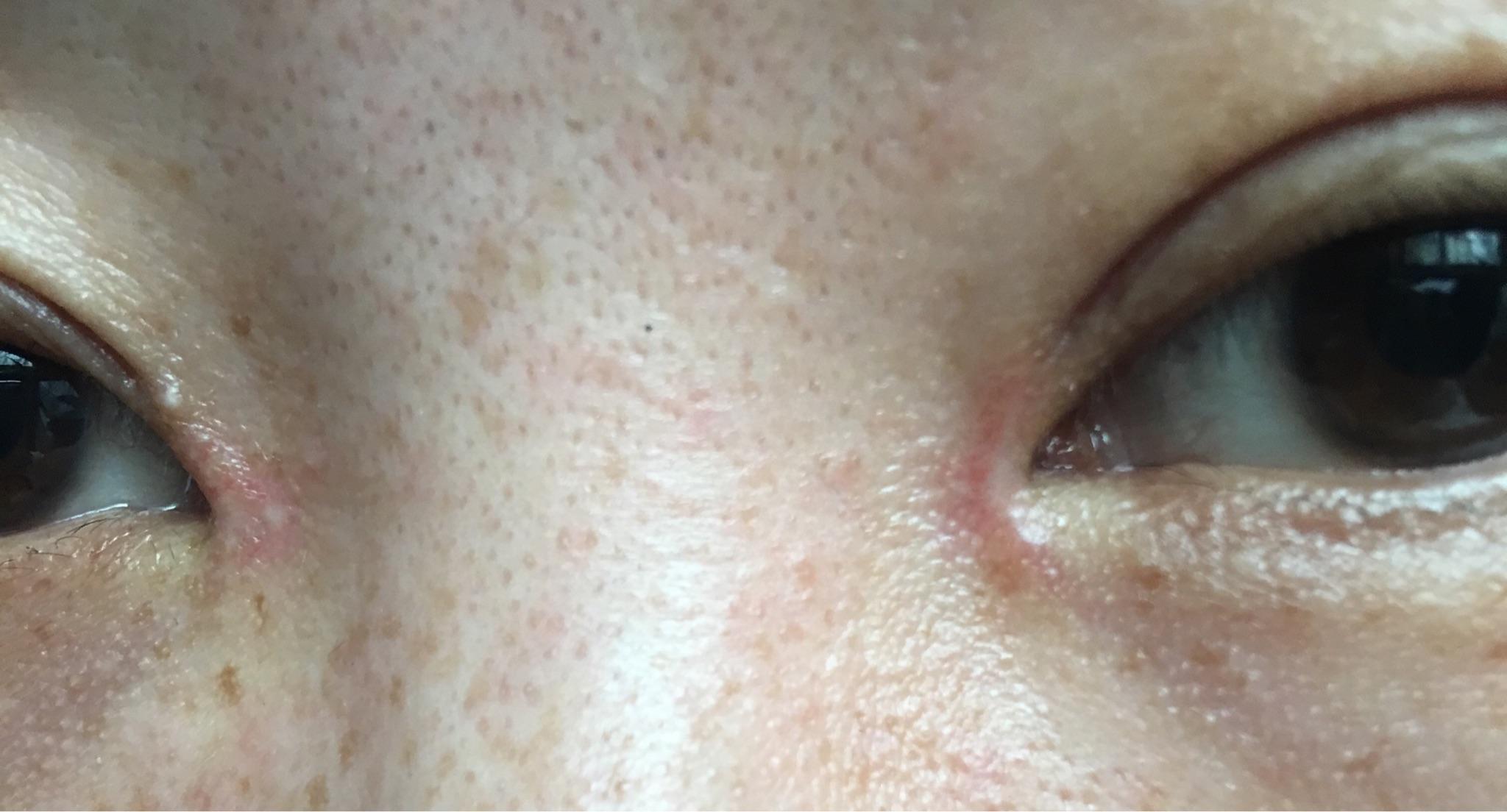 开眼角一个月,眼角掉痂后成了这样,中间是白的边上有点红,疤痕能恢复