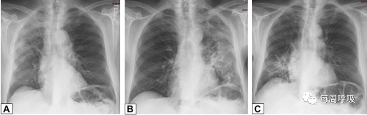 图片[4]-CHEST综述：机化性肺炎的诊断流程（临床-影像-病理特征相关性） | 每周呼吸-每周呼吸