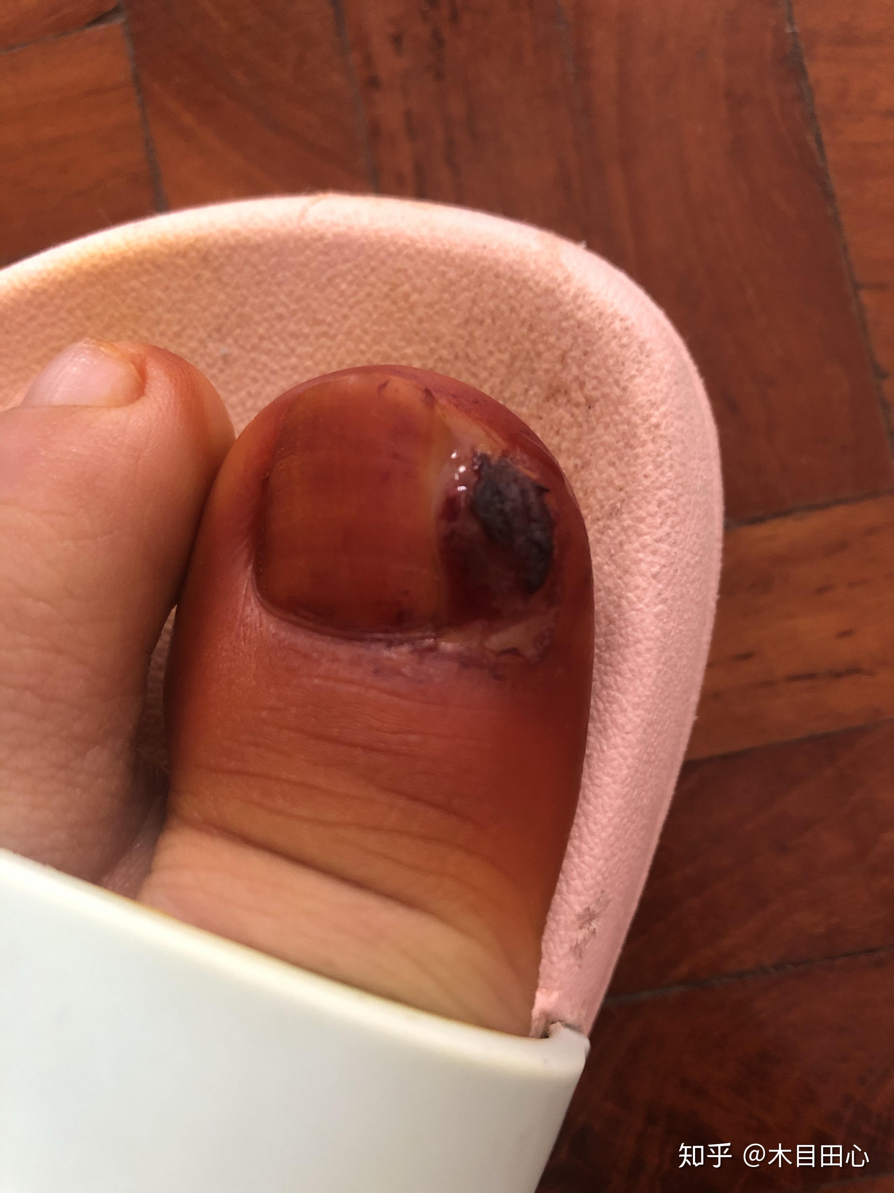得了甲沟炎,如何才能消除多余的肉芽? - 知乎
