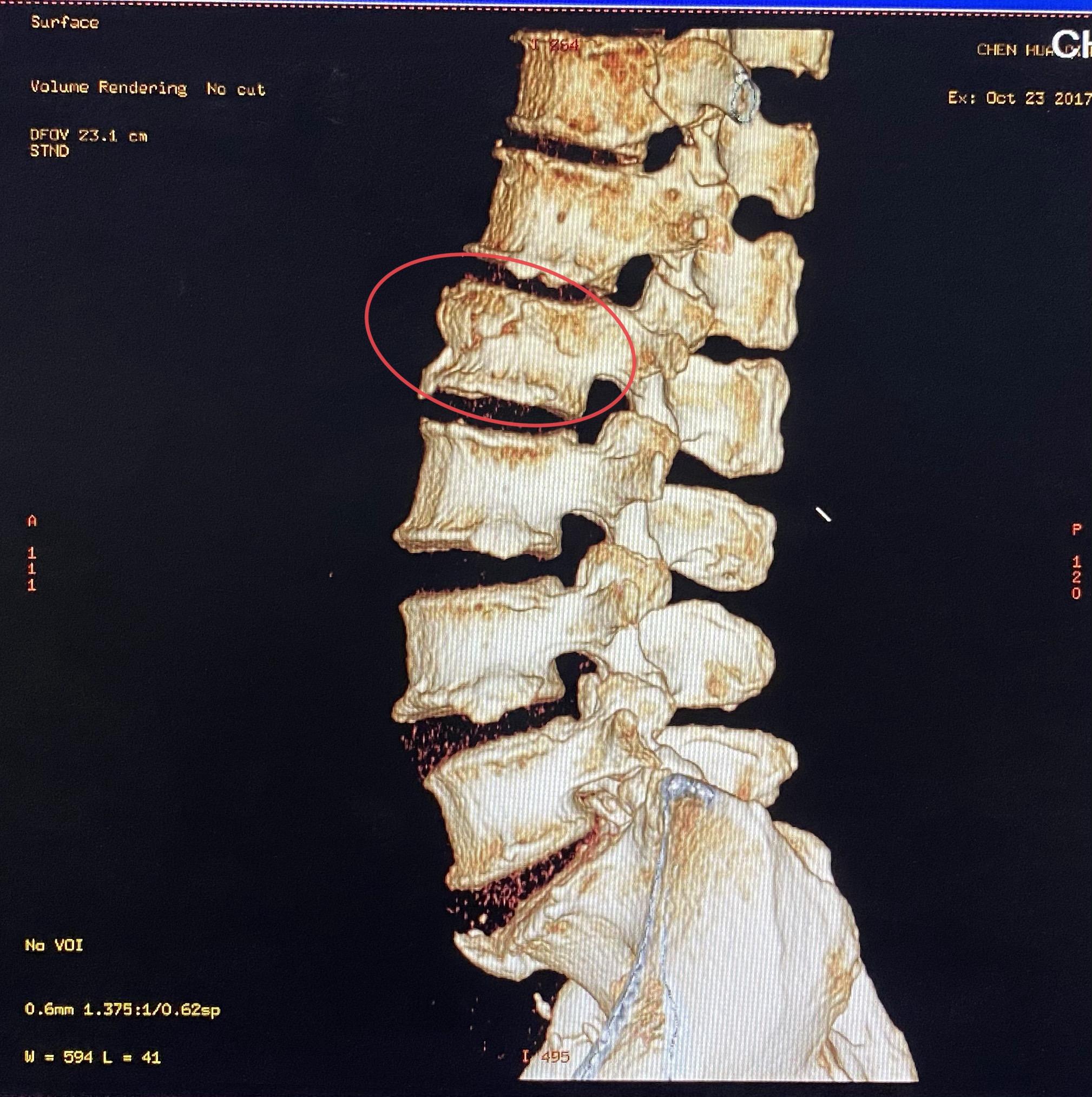 腰椎骨折片子图片