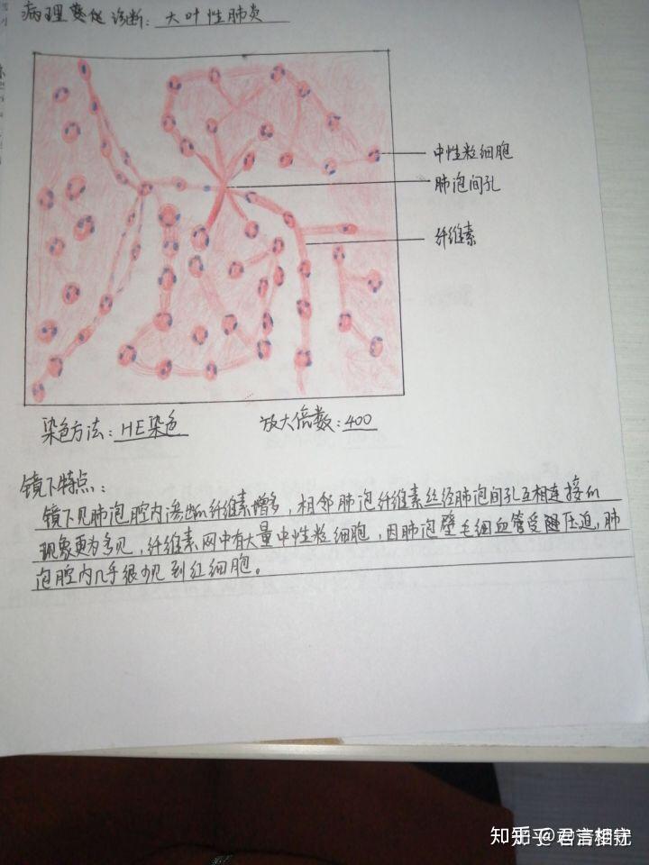 肺泡红蓝铅笔图片