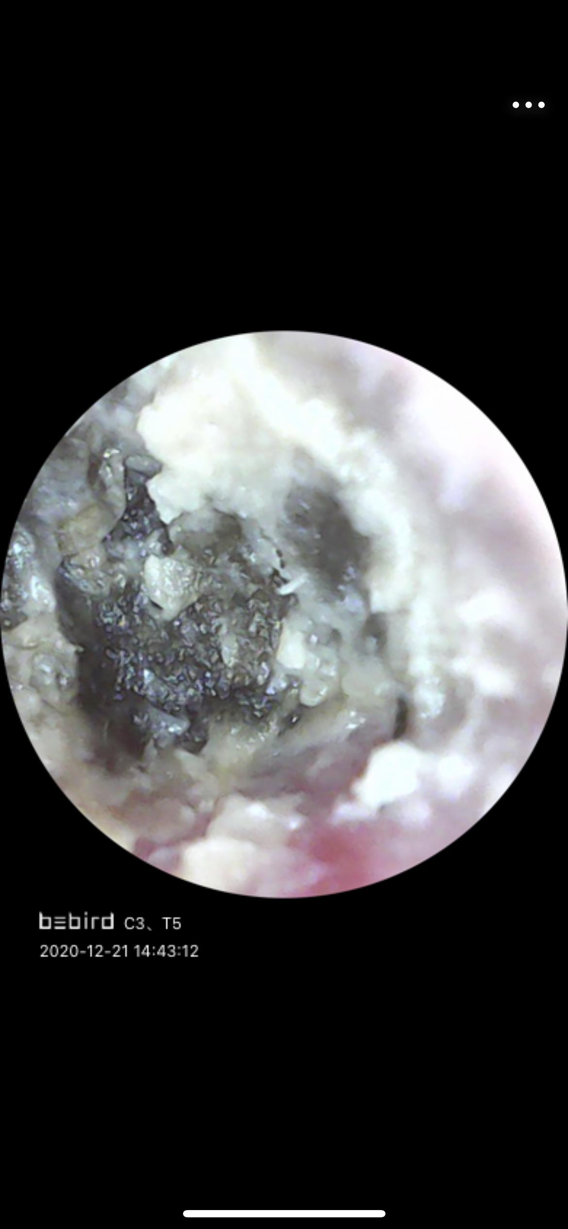 为什么我从来没掏出来过大号的耳耵聍