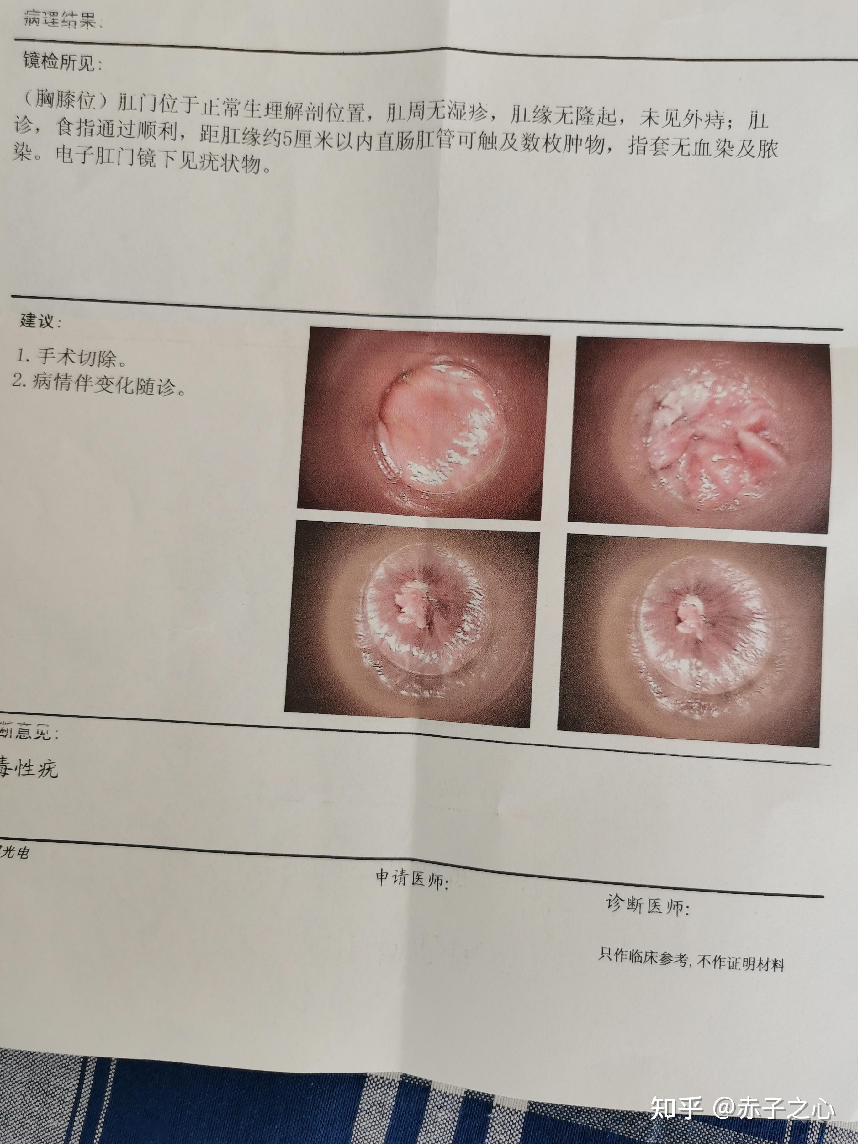 肛内尖锐湿犹图片