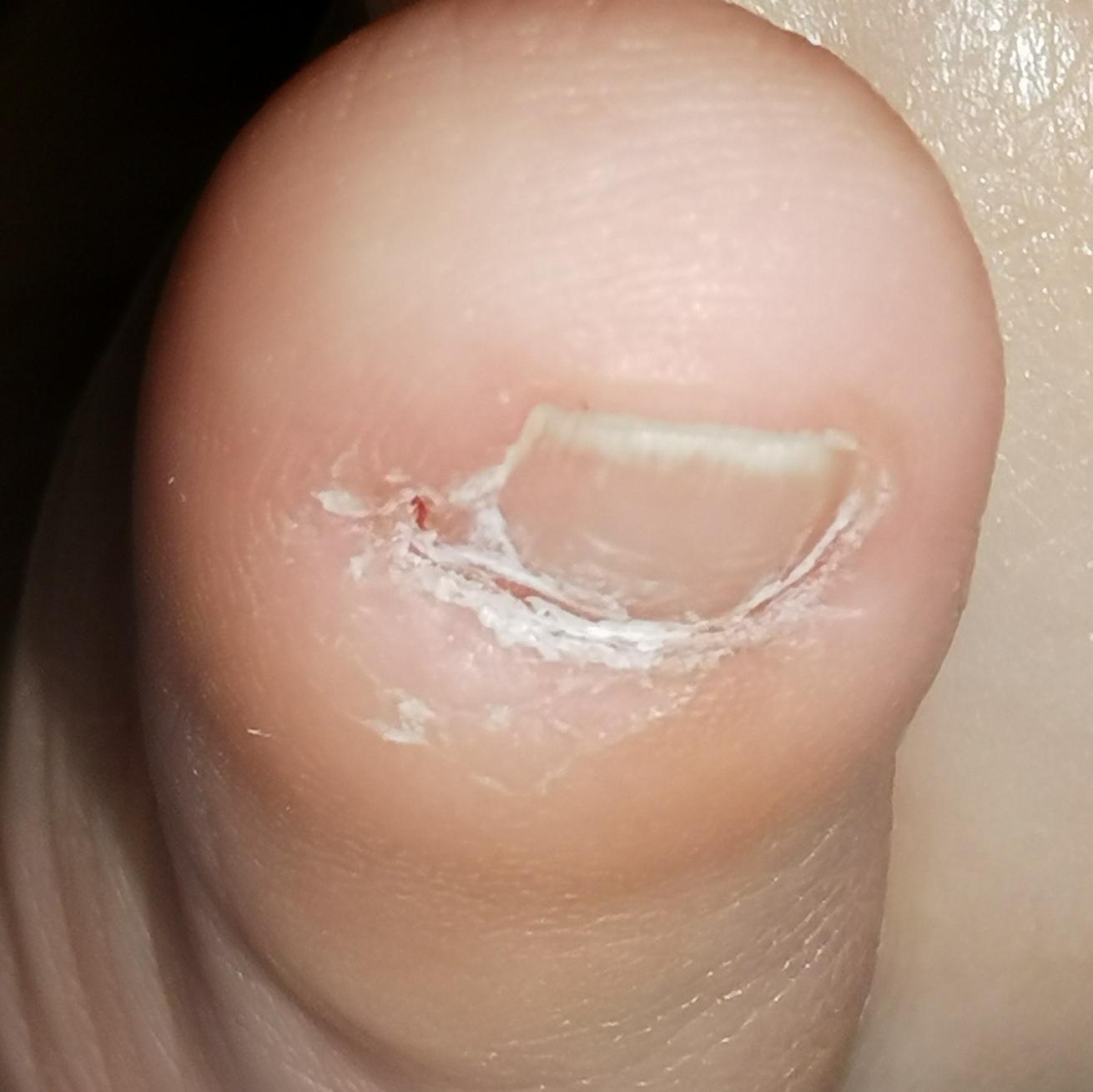 瓣状甲拔了还会长出来吗