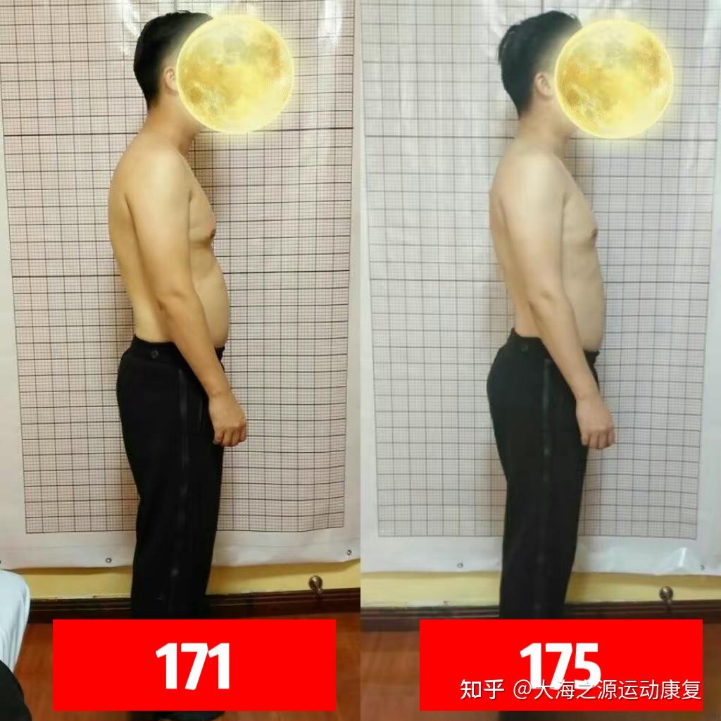 长期不良体态会使实际身高变矮吗？ - 知乎