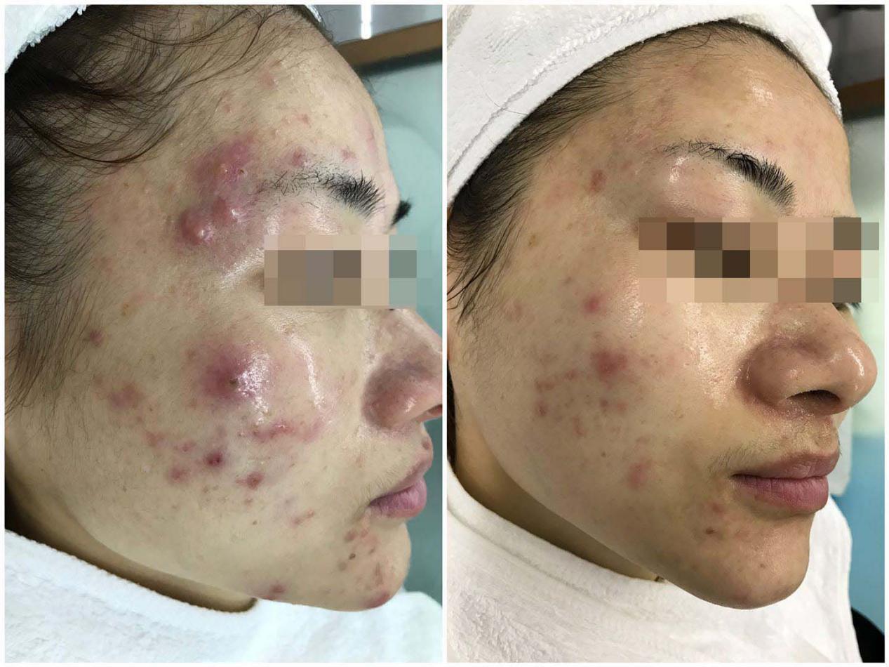 脸上长很大的痘痘