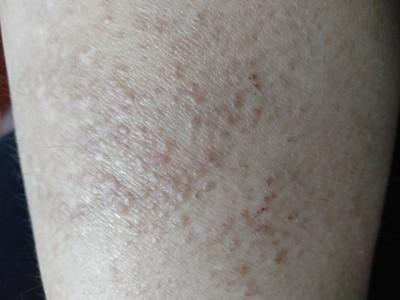 秋冬季皮肤干燥 瘙痒 原来是乏脂性湿疹 知乎