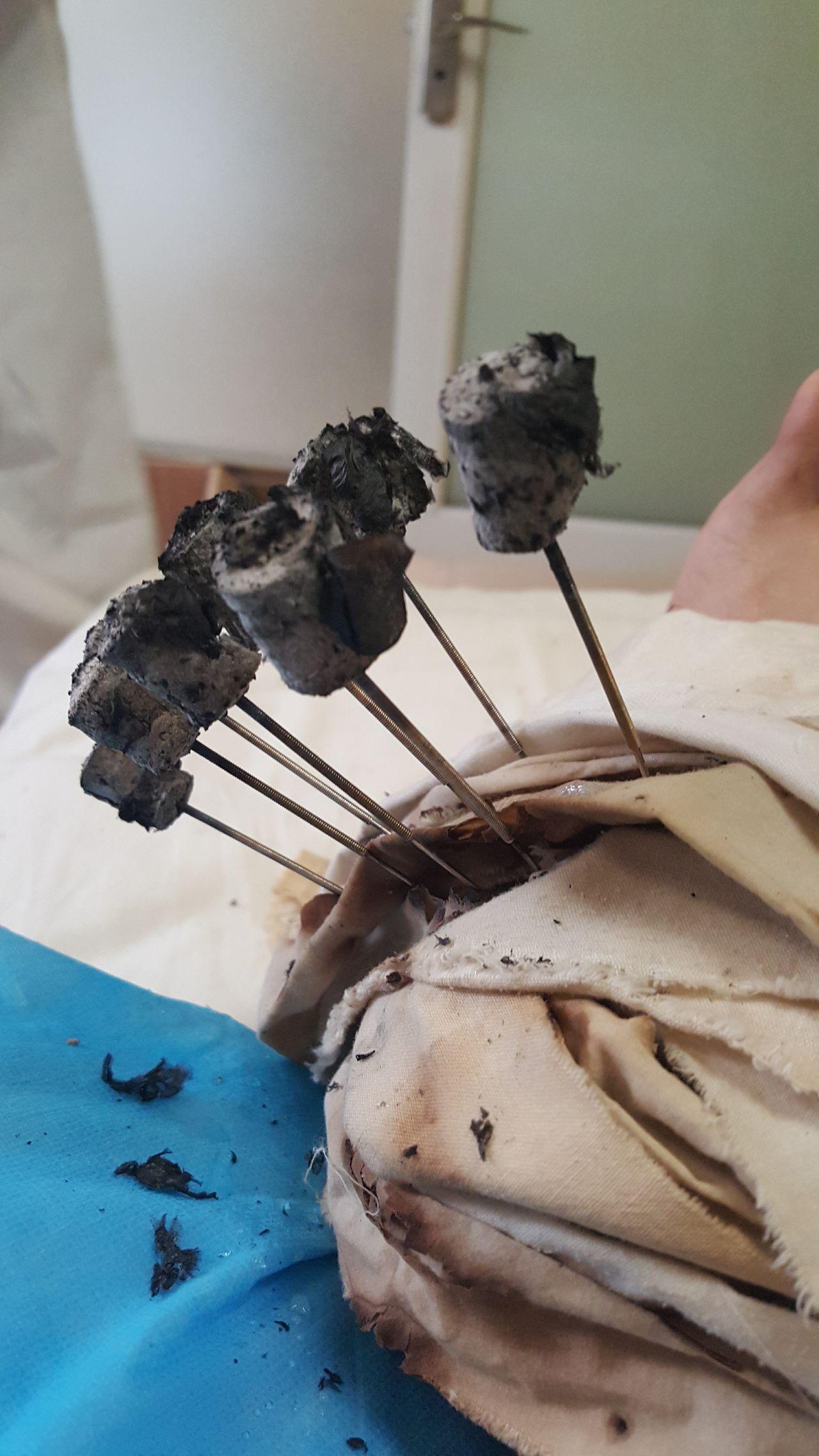 有谁了解密集型银质针松解术么?