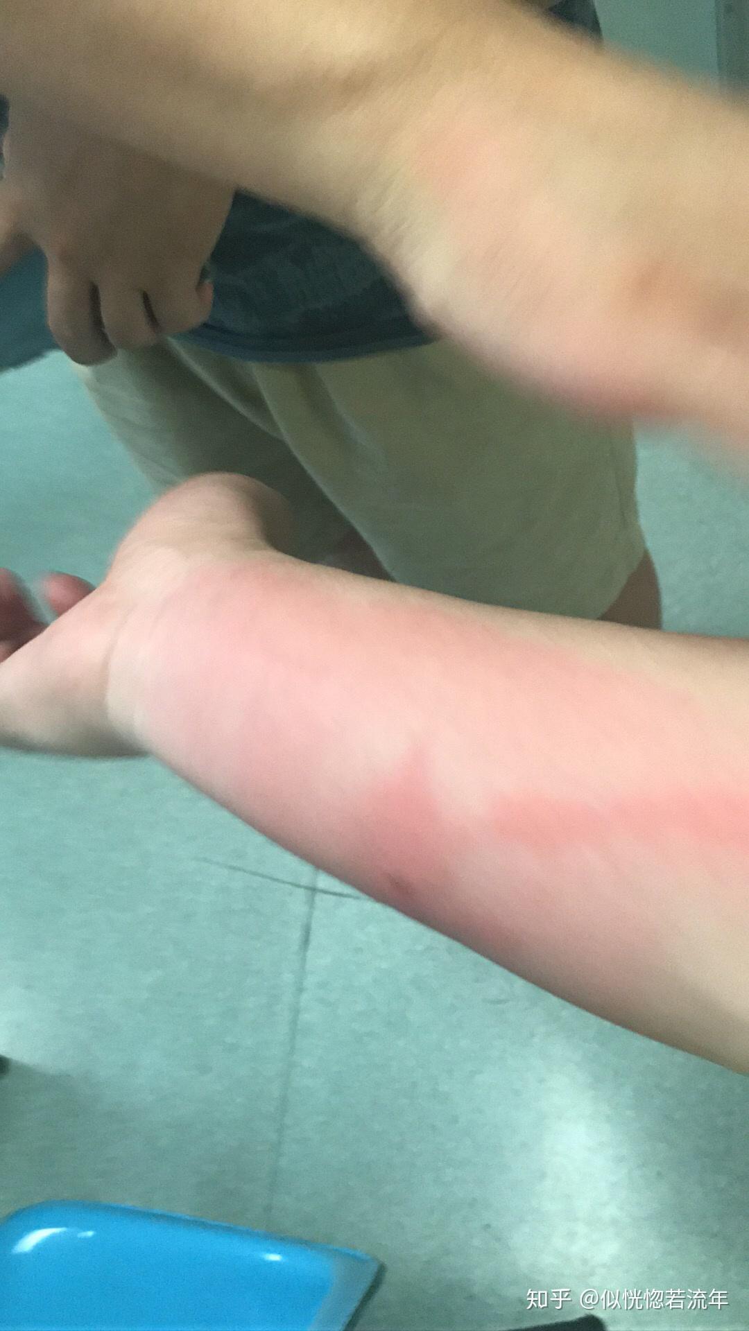 被虫子咬了胳膊上一条红线往上延伸这是什么