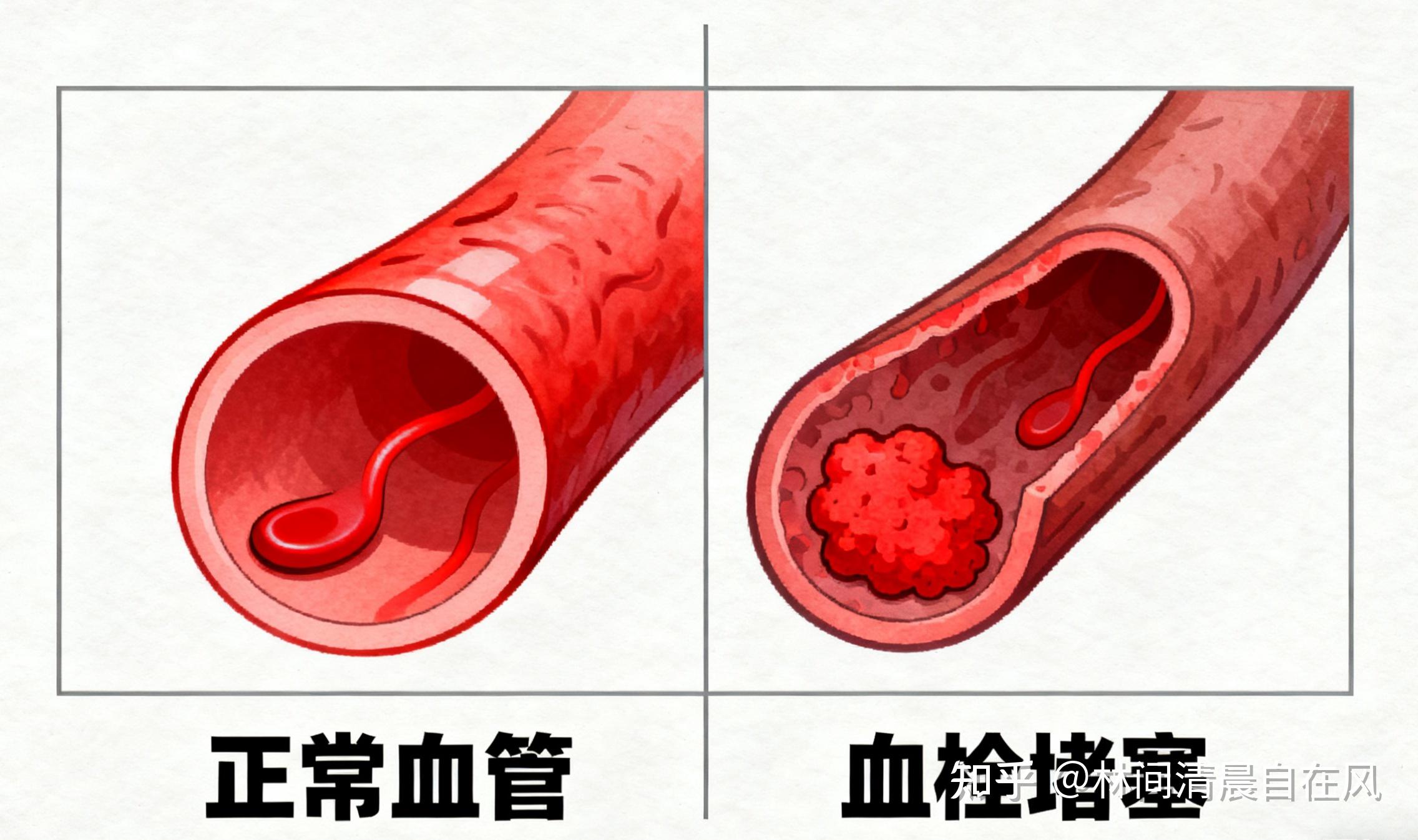 血栓有什么症状和预兆? - 知乎