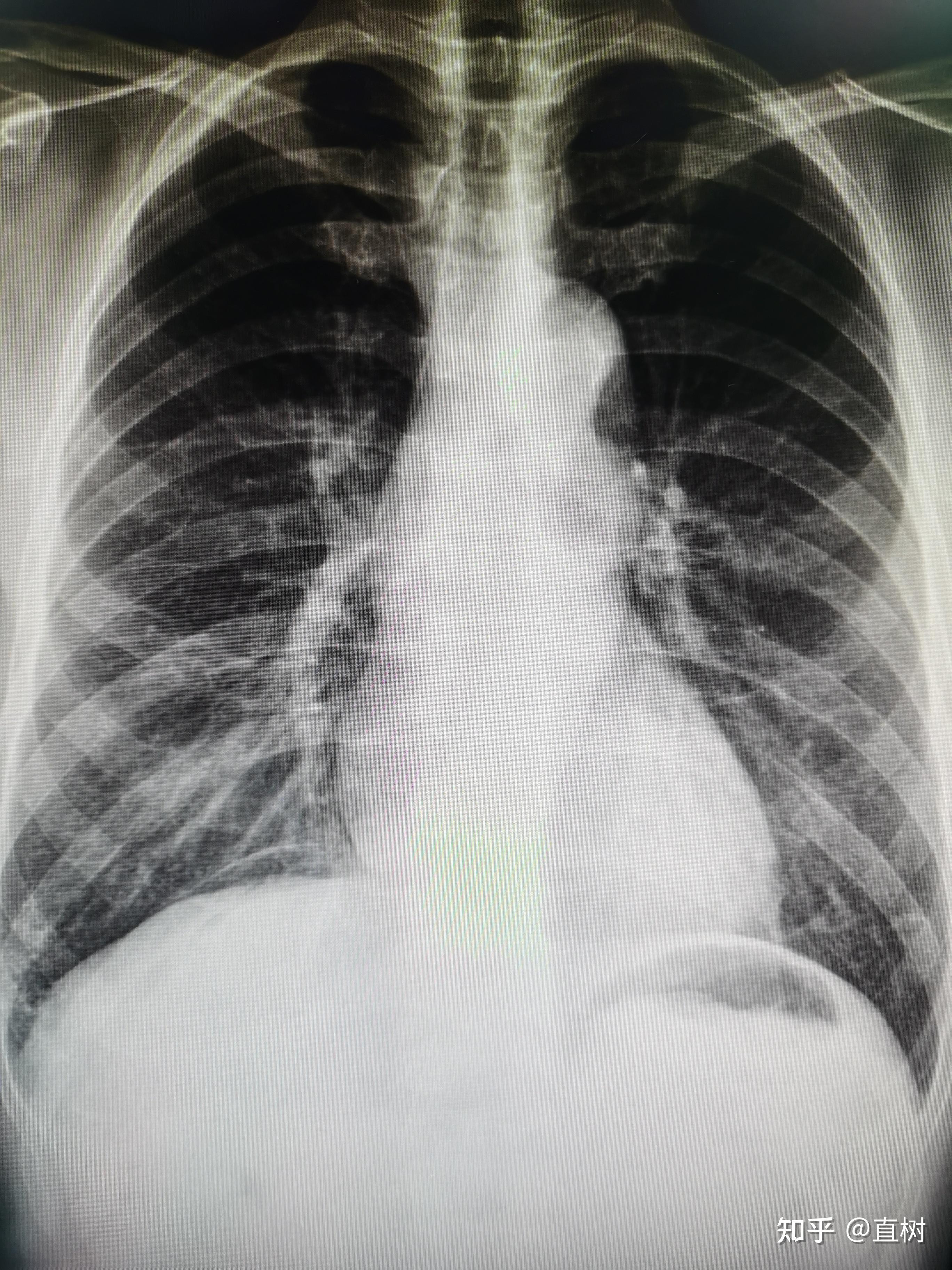 去办健康证,胸透 便检 验血 他们是真的会检验什么的嘛?