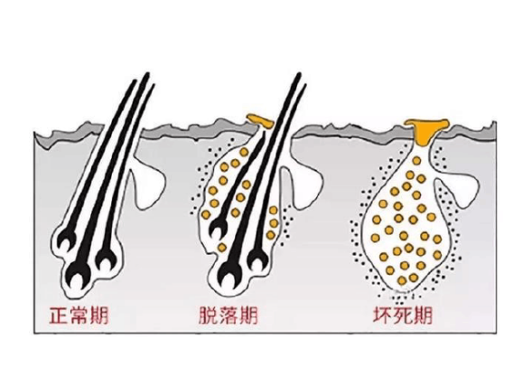 头皮的毛囊是怎样萎缩的？ - 知乎