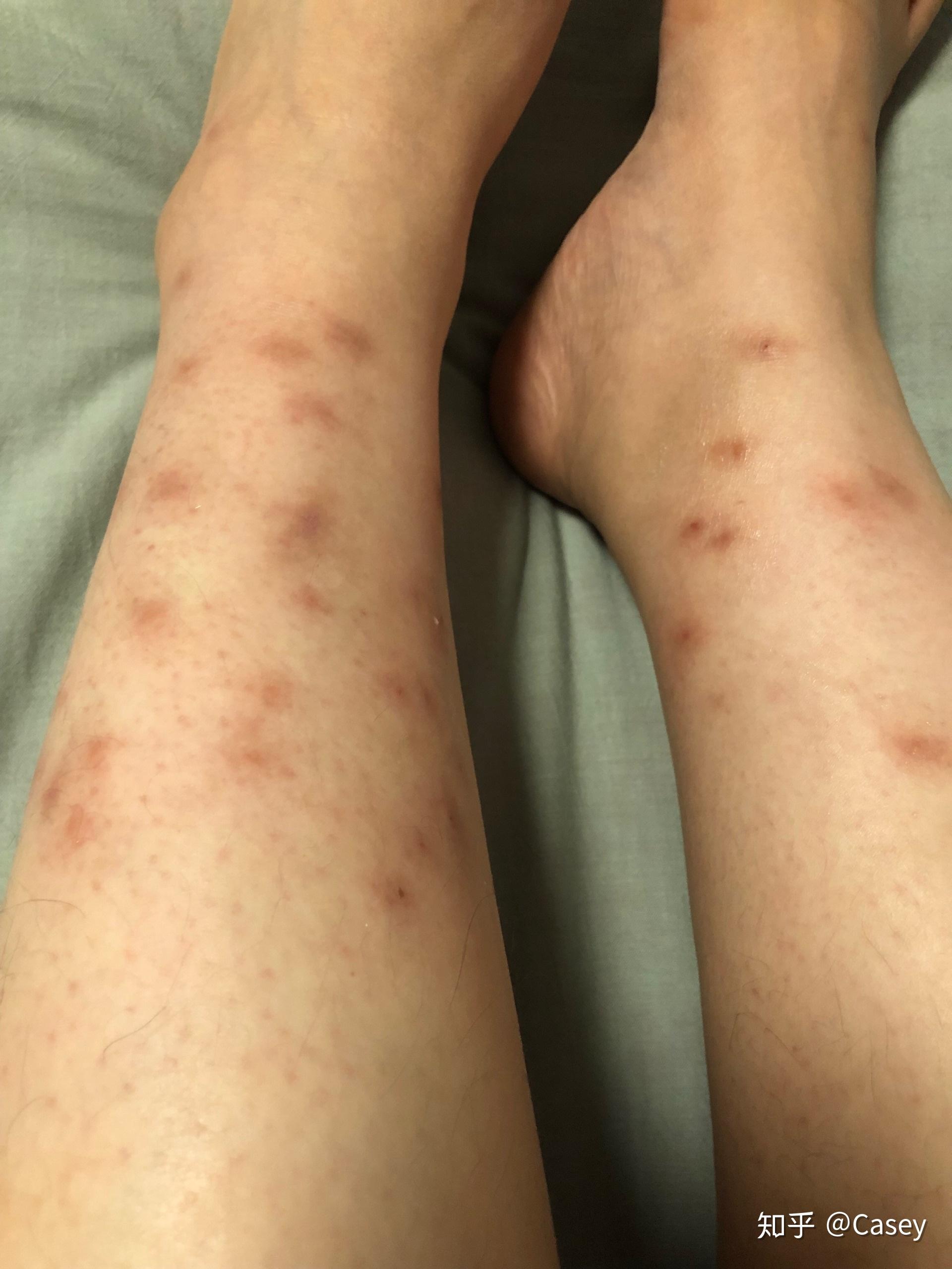 如何防止被黑蠓叮咬及叮后处理方法