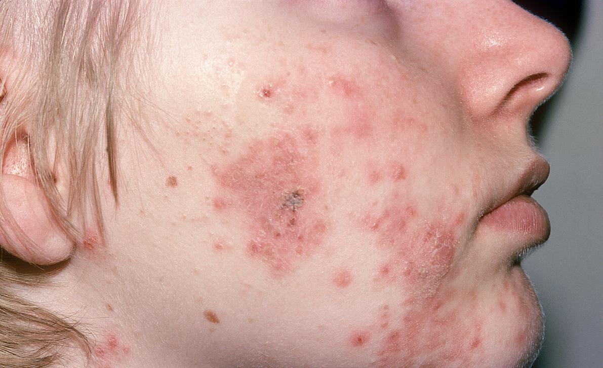 痘痘敏感肌到底要不要做面膜? - 知乎