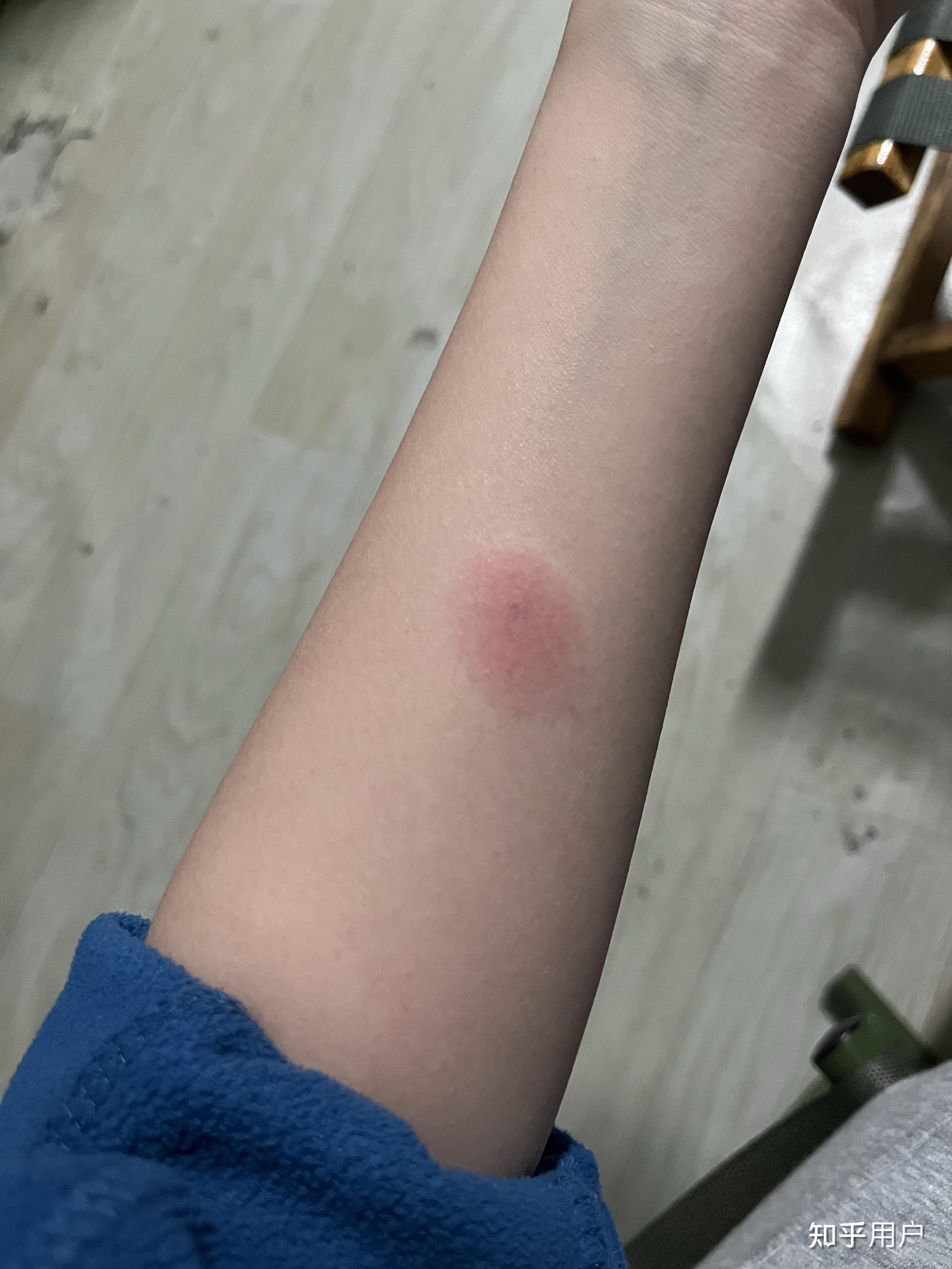 ppd皮试后这个样子怎么办? - 知乎