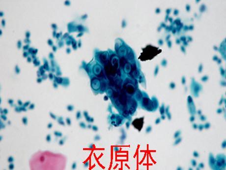 衣原体感染有哪些治疗方案