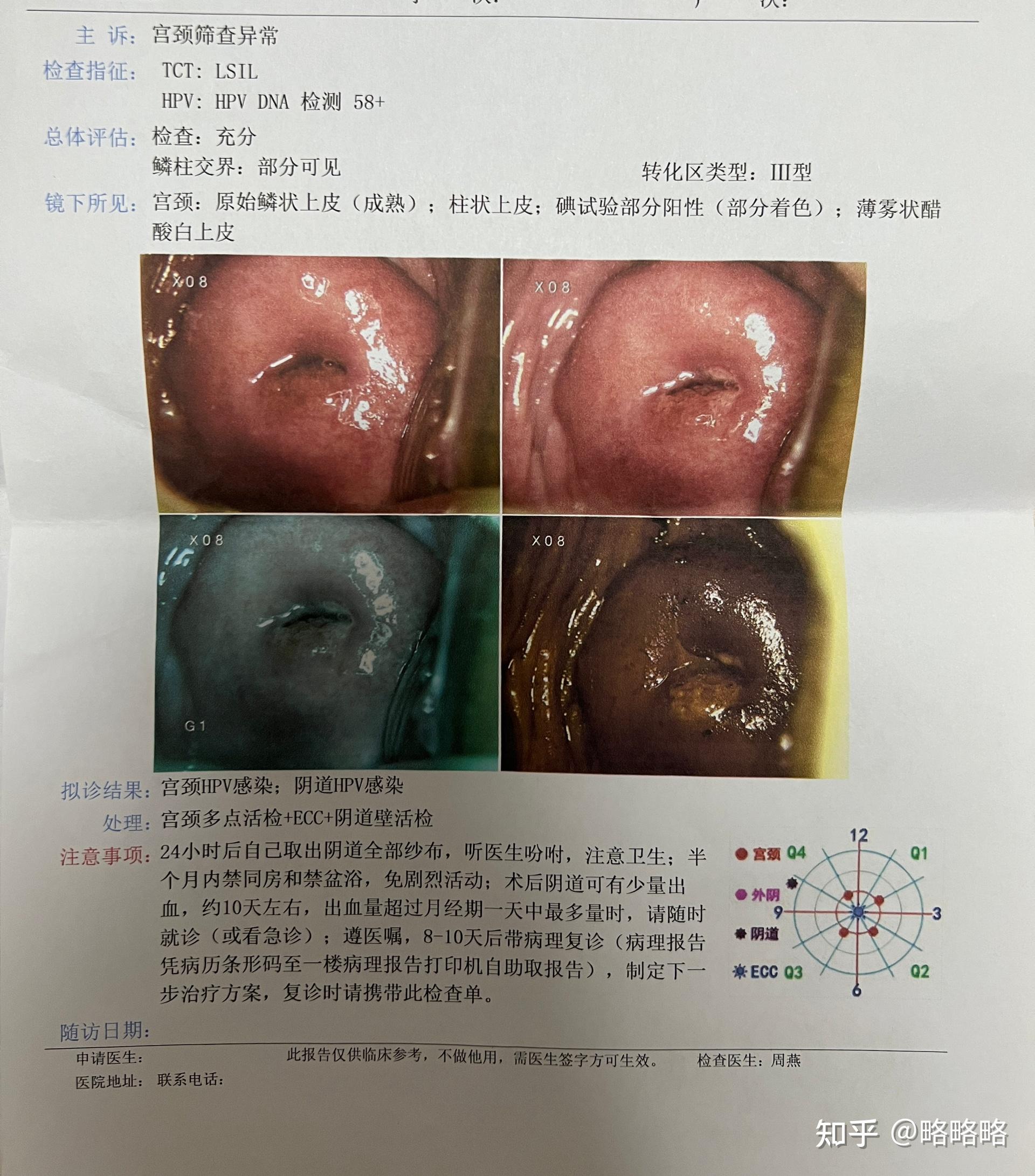 2个月的检查最终hpv阴tct低度病变,阴道镜活检病理宫颈组织慢性炎伴鳞