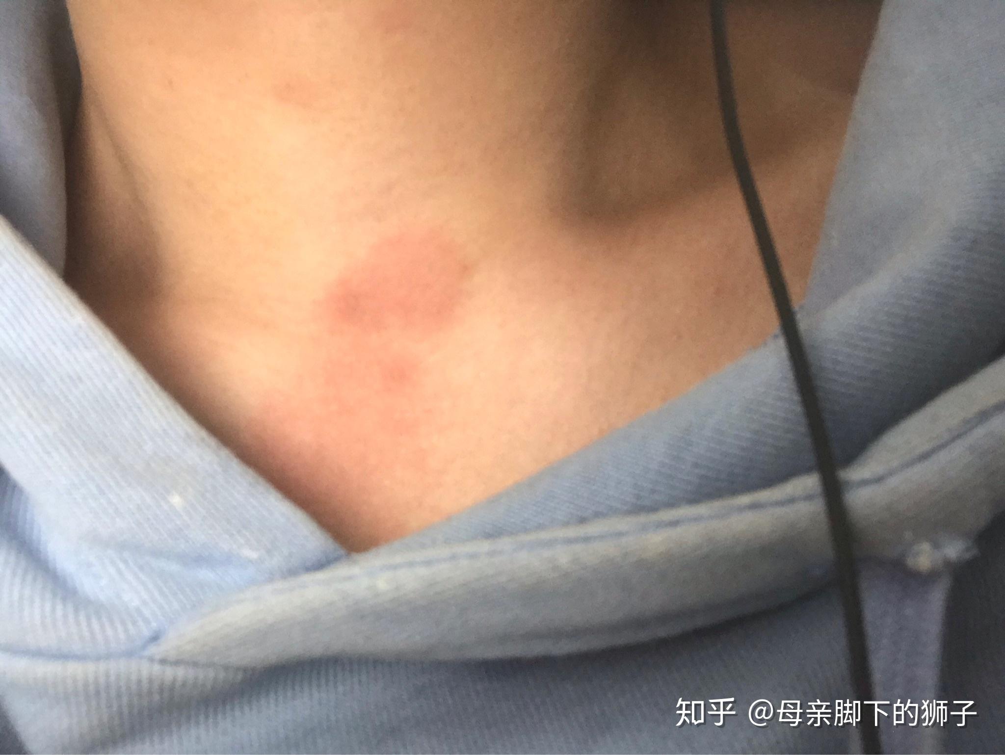 在男友(女友)脖子胸上种"草莓"真的很容易吗? - 知乎