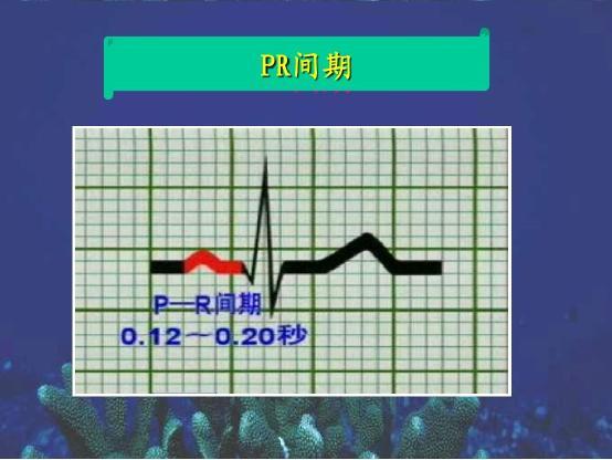 招飞体检常见心电图术语及鉴定:短pr间期