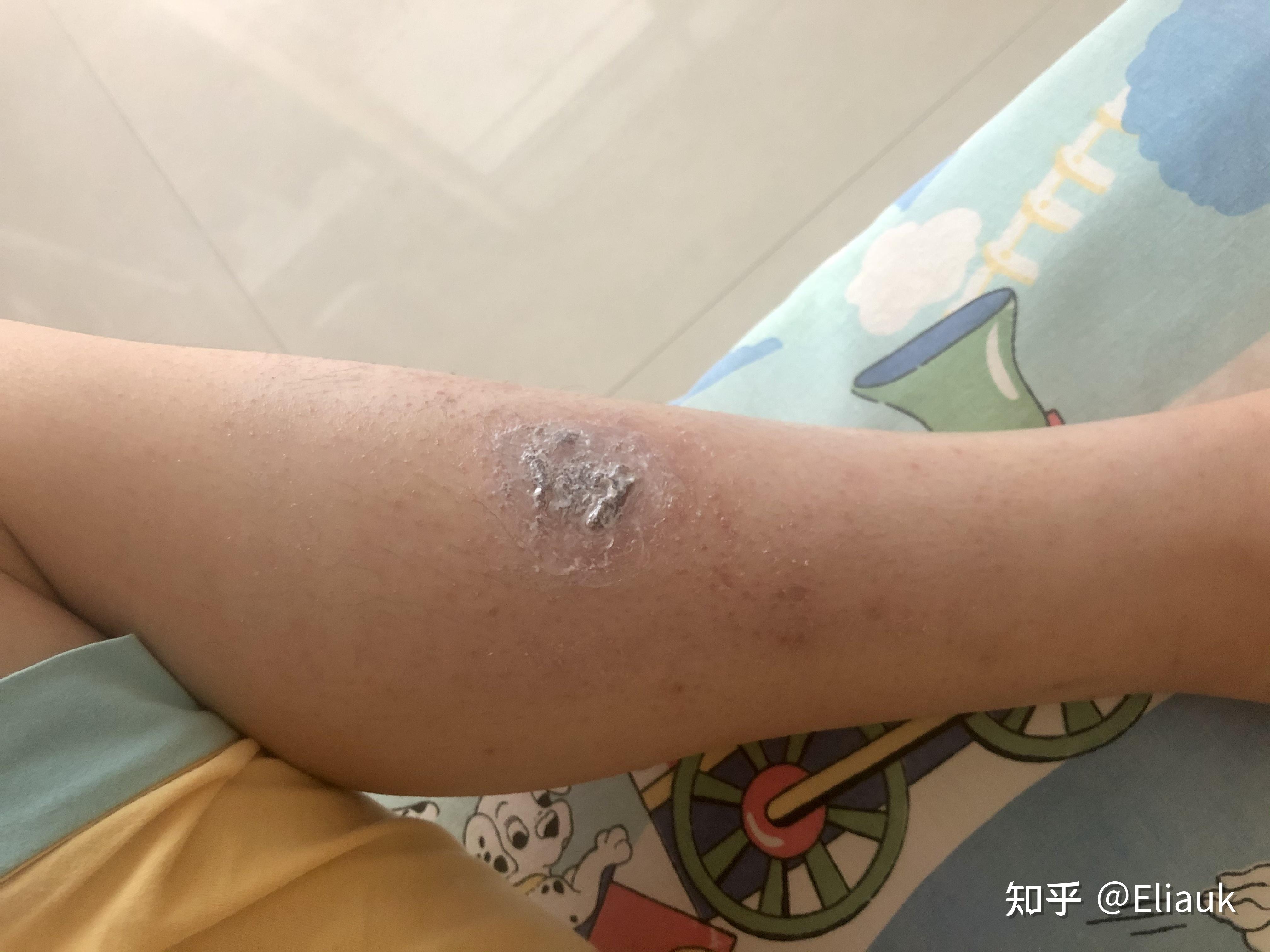 擦伤后的处理，伤口化脓了？ - 知乎