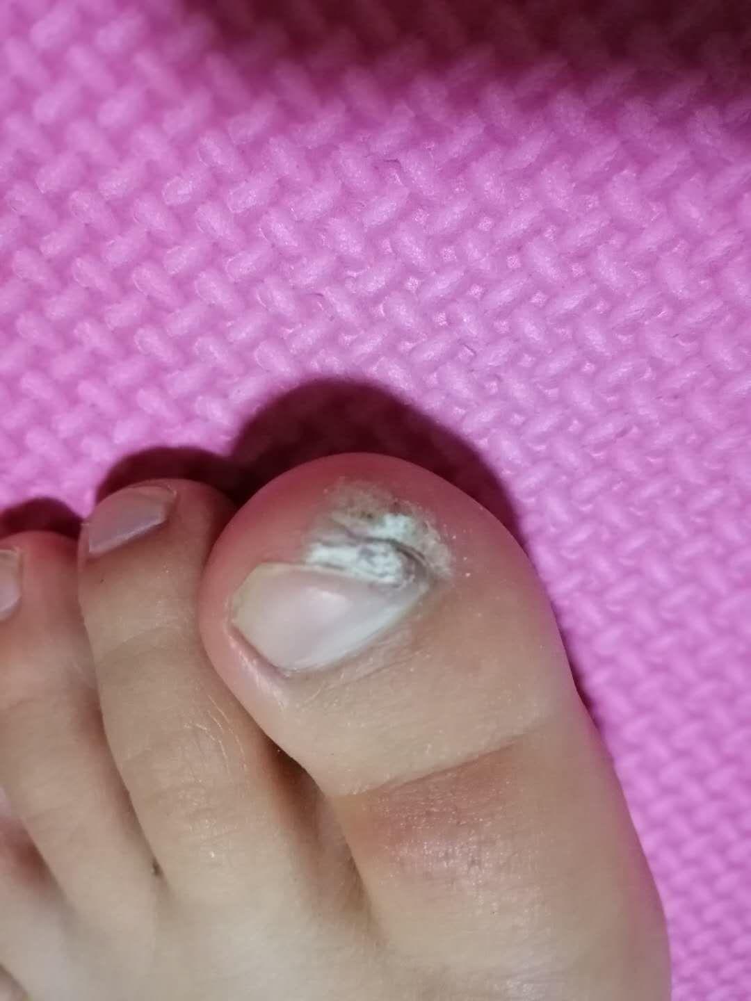 手指长了个甲周疣,激光治疗后现在是这样,请问是不是仍然会复发?