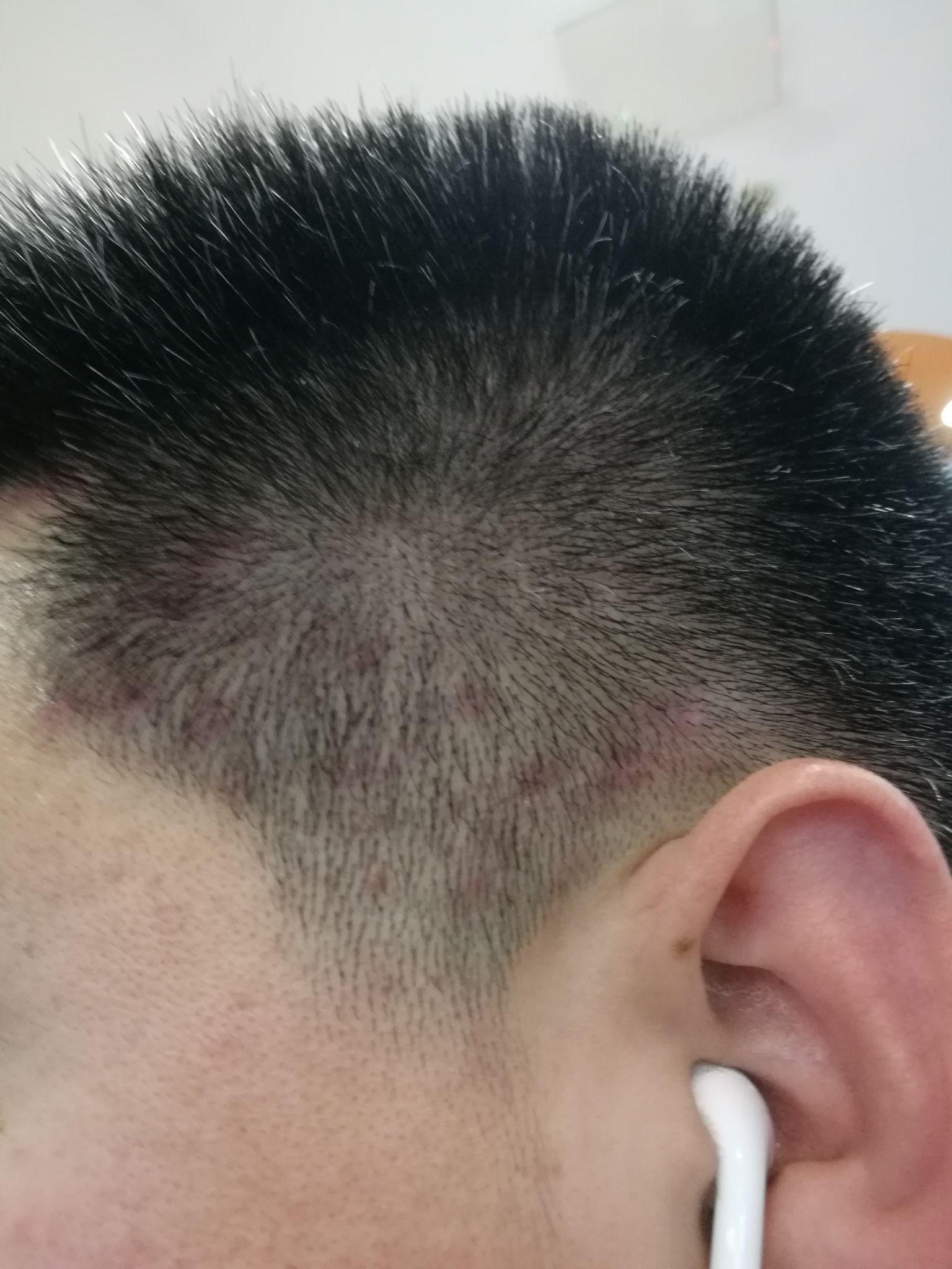 头皮上脂溢性皮炎和毛囊炎共生多年你们有根治的么一起交流一下吧