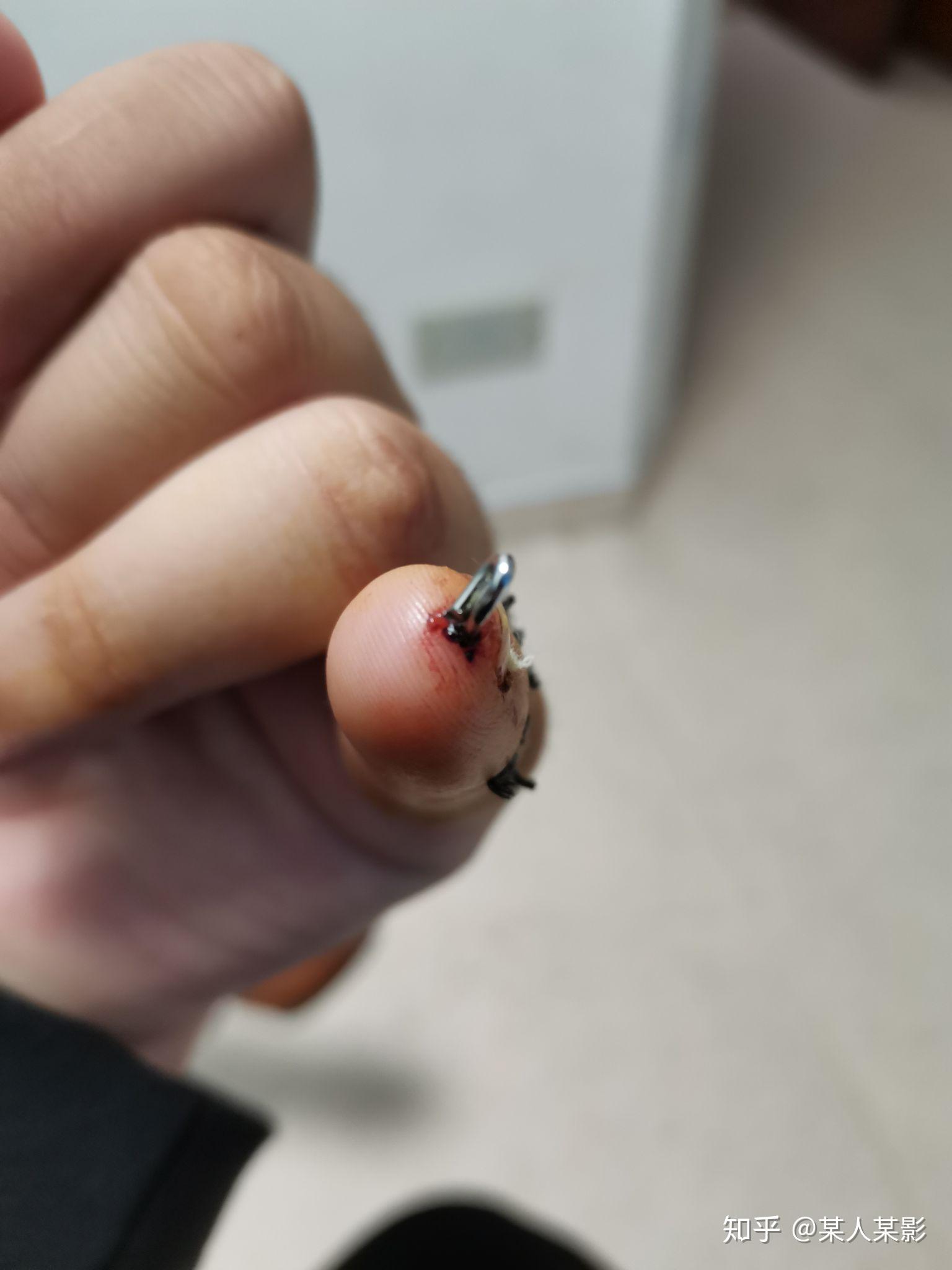 手指切断了还能康复吗