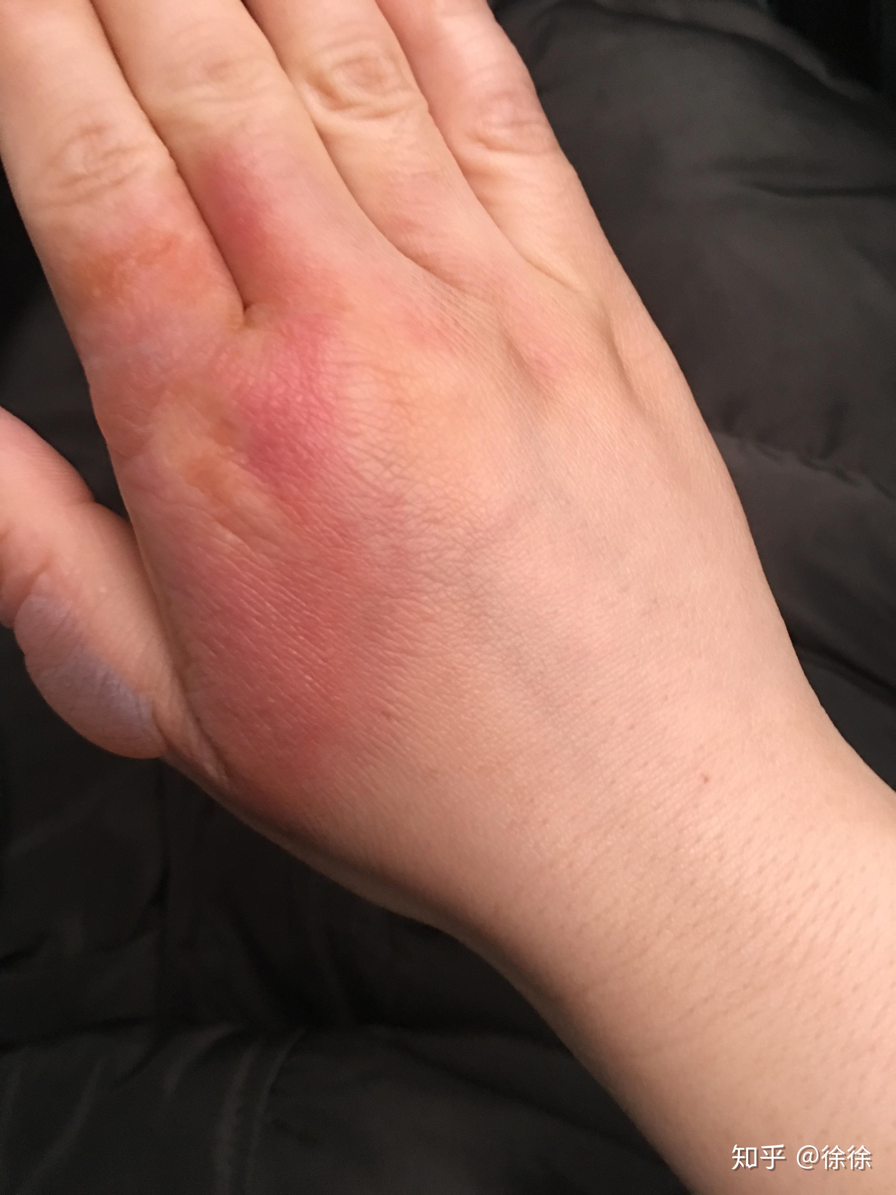 烫伤起的水泡可以戳破吗? - 知乎