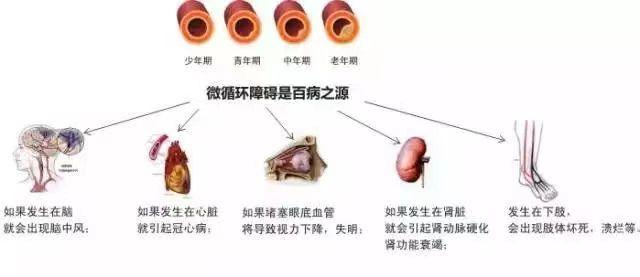 脑梗原因图片