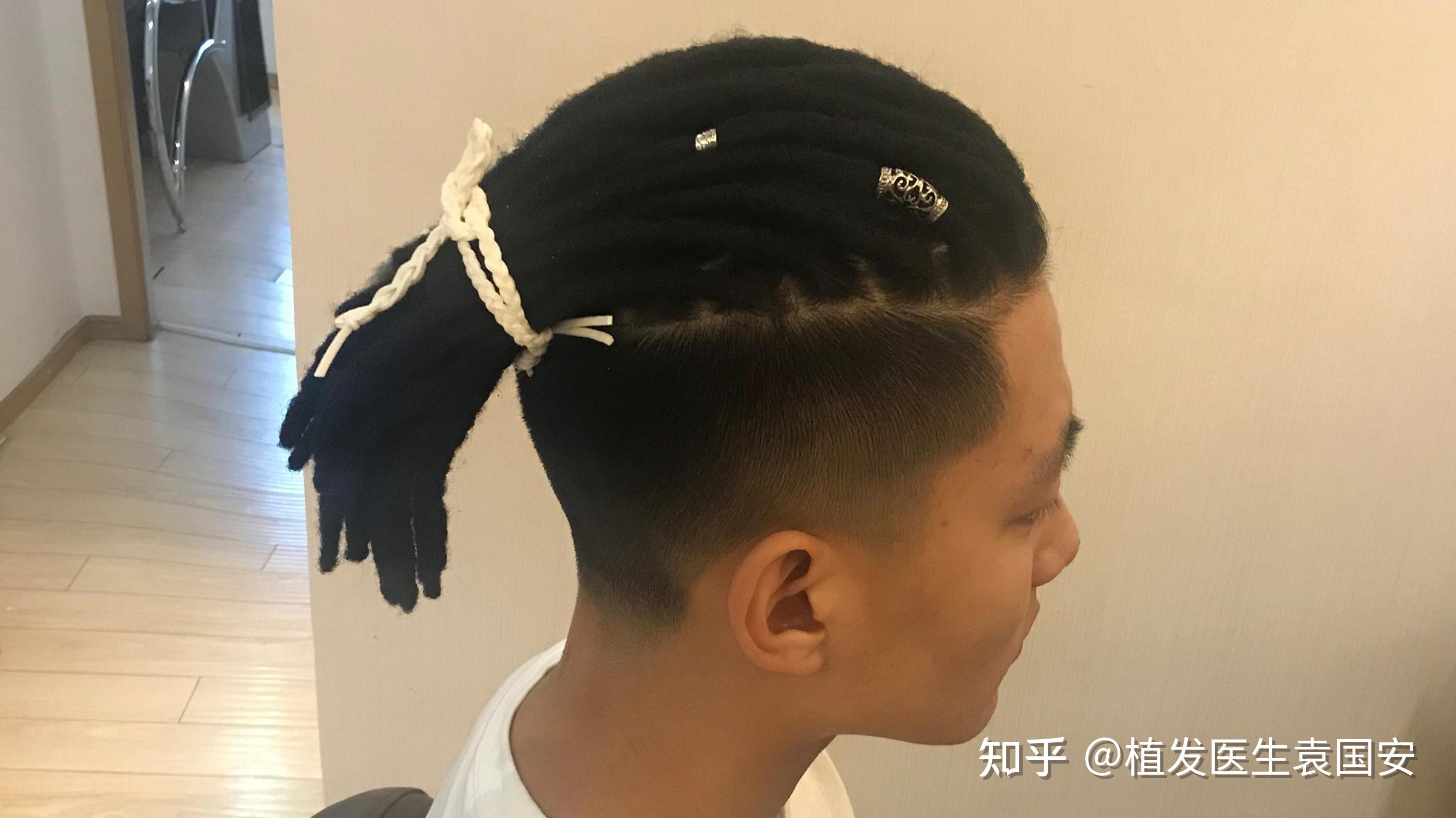 剃光头有助于改善脱发吗？ - 知乎