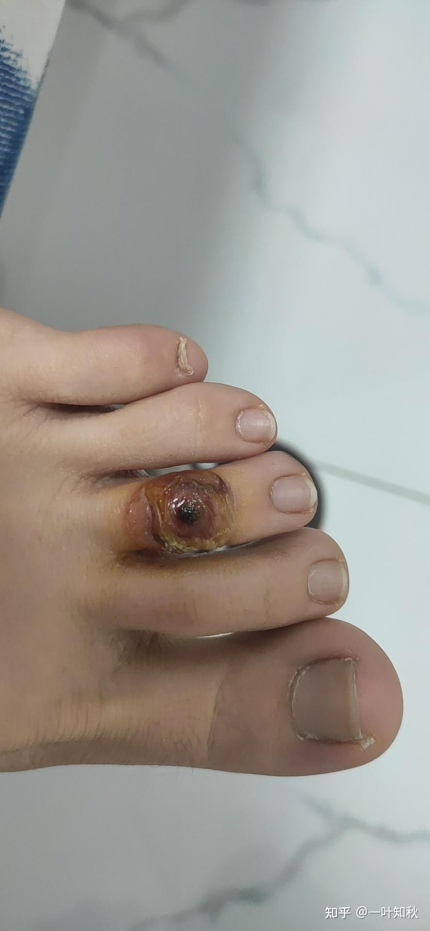 液氮冷冻治疗后手指上出了血泡而且越来越大该怎么办