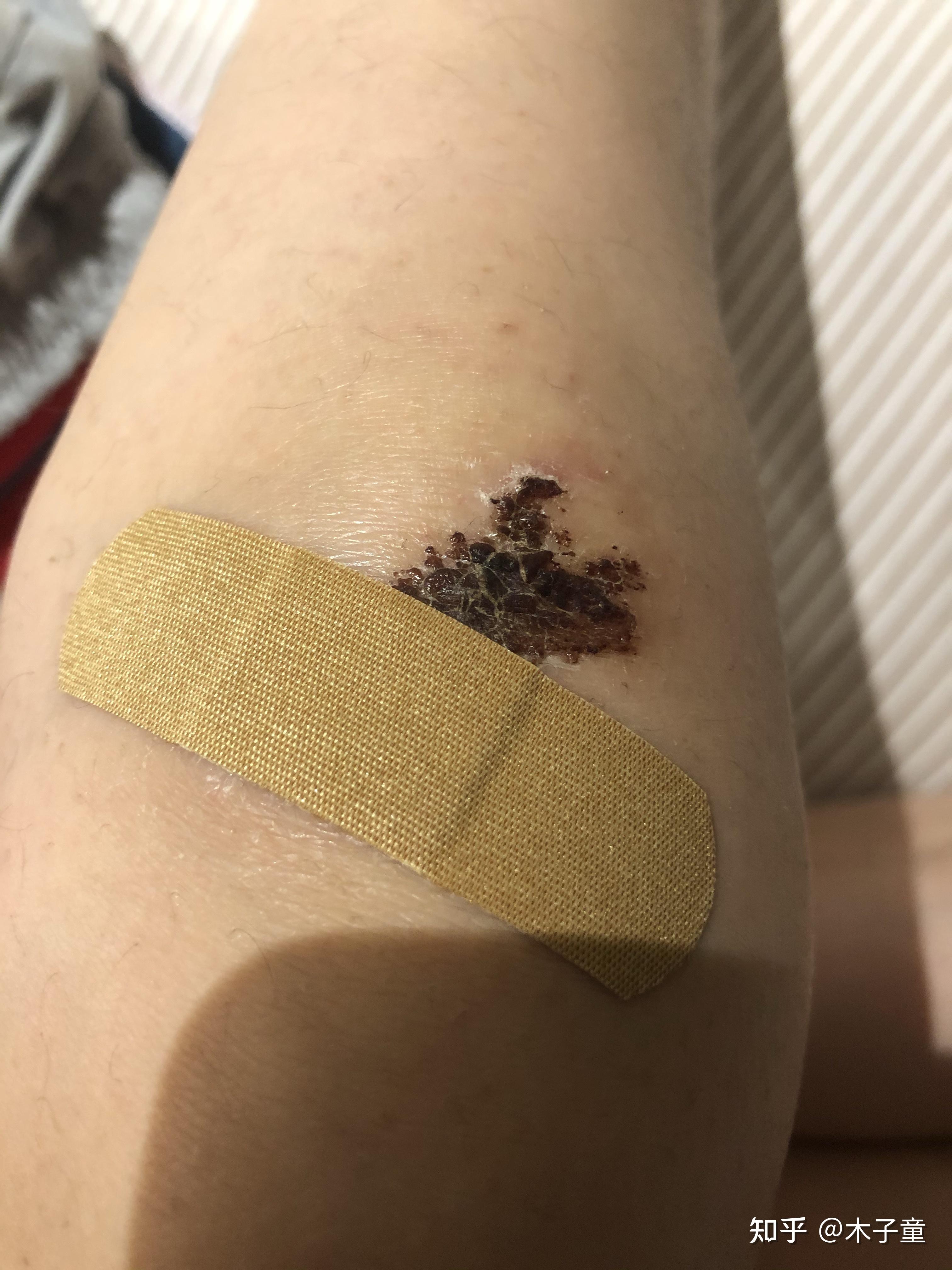 伤口结痂如何忍住手贱