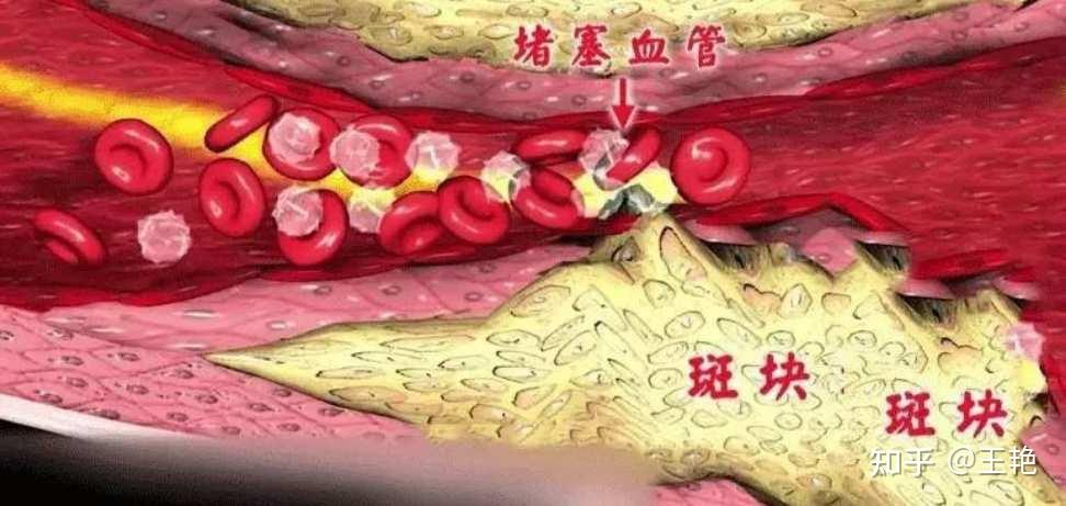 血栓来了？别怕，七种食物拯救你！ - 知乎