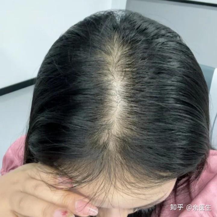 发量越来越少,怎么短时间内使发量变浓密?