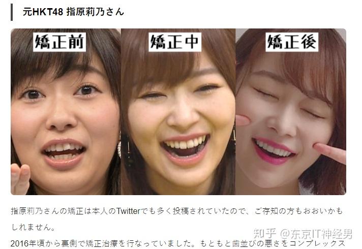 日本人为什么牙齿乱但是很少正畸?