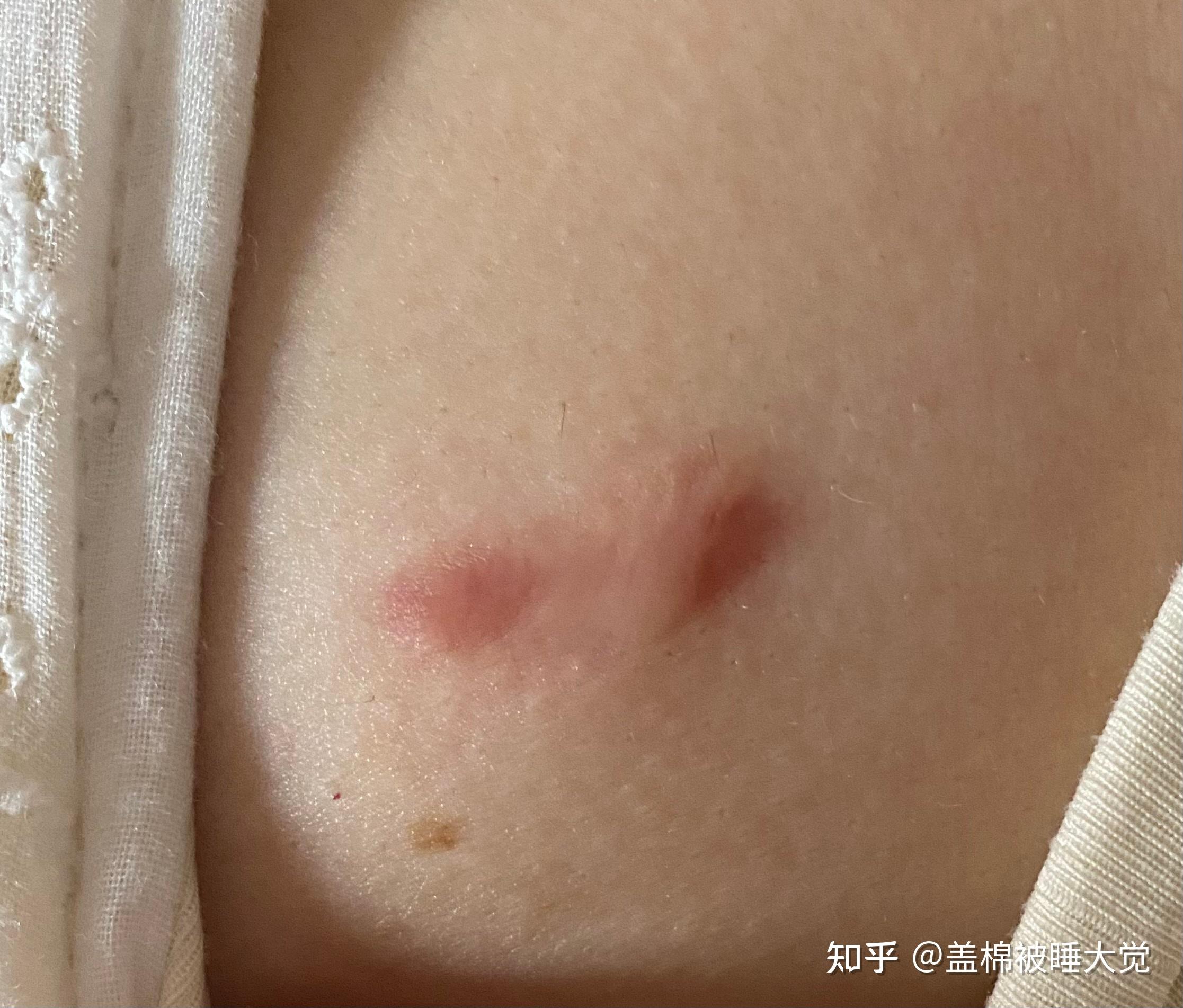 乳腺纤维瘤手术留的疤痕到是什么样子手术会不会很疼明早做手术疤痕会