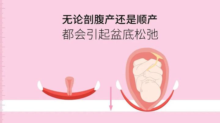 10个顺产,8个会阴撕裂!减轻裂伤的方法你知道吗? - 知乎