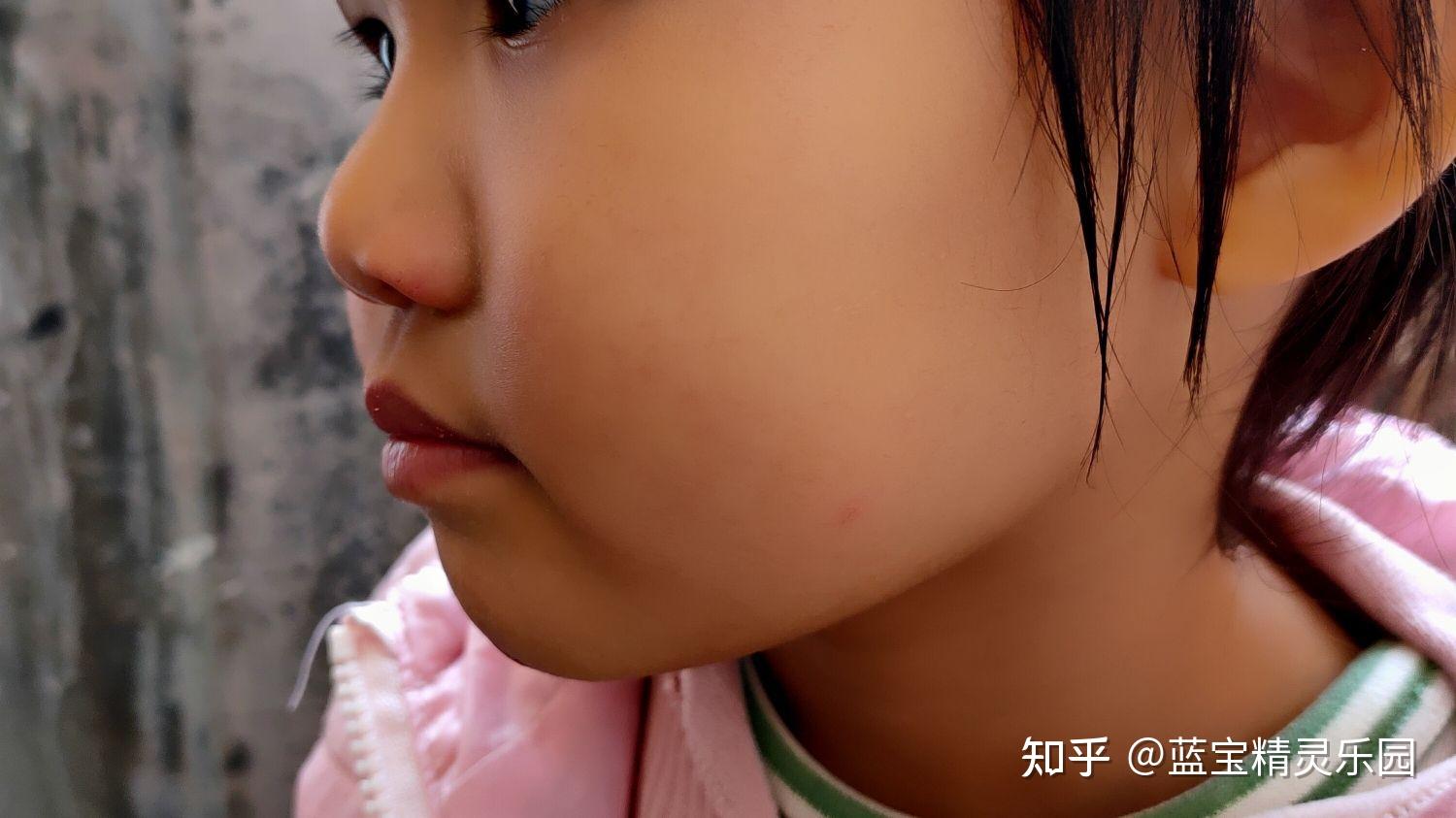 宝宝脸皲裂了,有什么好推荐的面霜摸脸,宝宝皮肤有点敏感哦. - 知乎