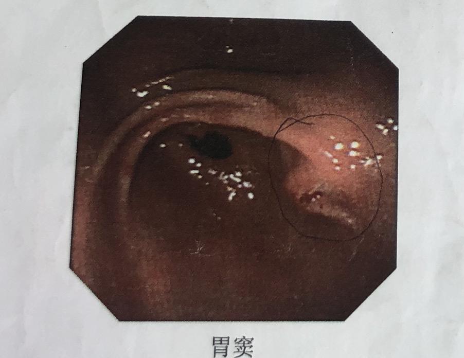 异位胰腺普通胃镜看到的是什么样子的