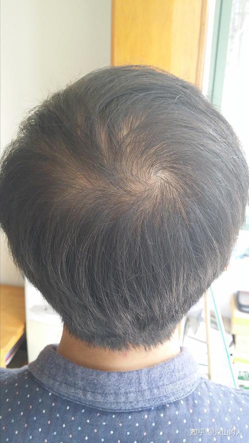 我头顶漩涡头发的发量正常吗? - 知乎