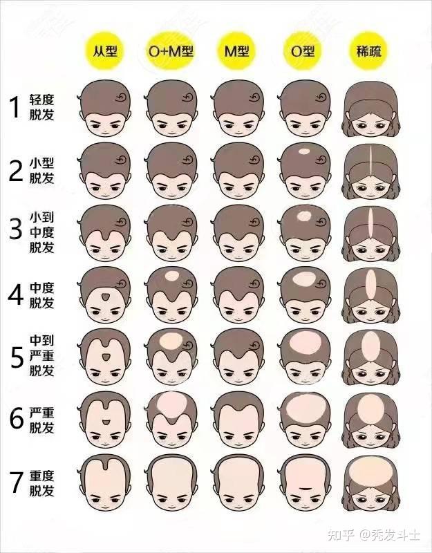 头顶头发多少算正常图片