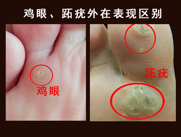 脚上小疙瘩长到“菜花”状,是跖疣? - 知乎
