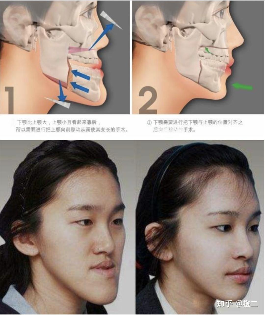 正颌手术真的有必要做吗?正颌术后能否达到标准面型?附正畸or正颌自测 - 知乎